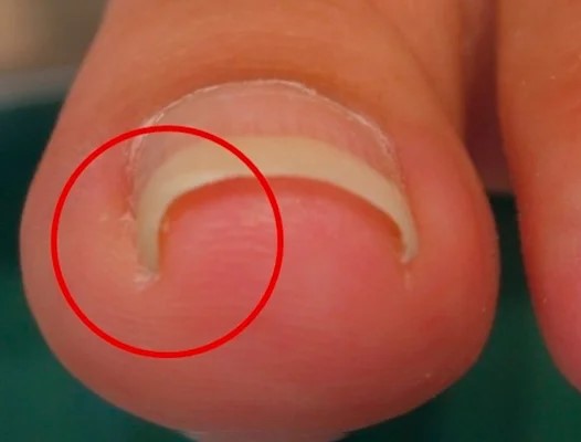 вросшие ногти